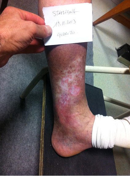 uurina picioarelor împotriva varicozei